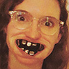 a person wearing glasses looking at the camera with rows of hematite in her mouth that look like large, gray teeth
